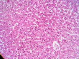 格雷夫斯病 格雷夫斯病