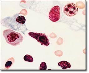 再生障礙性貧血