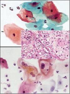 鱗狀細胞 鱗狀細胞