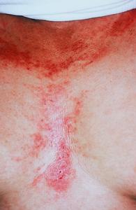 幼年型類風濕性關節炎