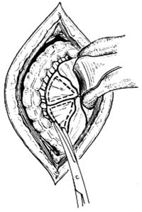 腎胚胎瘤 腎胚胎瘤