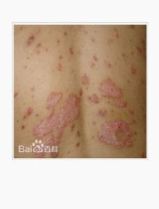 環狀或輪狀銀屑病