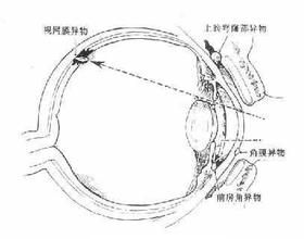 眼內異物 眼內異物