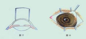 蠶蝕性角膜潰瘍