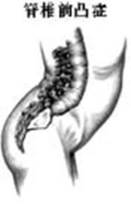 脊柱前凸 脊柱前凸