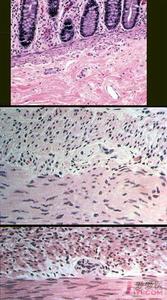 先天性巨結腸症