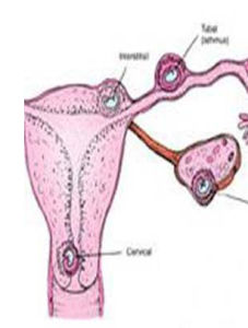 輸卵管炎 輸卵管炎