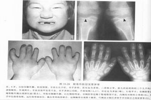 進行性骨幹發育不良