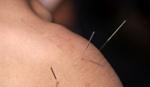 針灸治療神經性皮炎