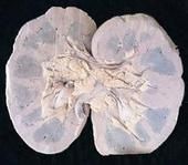 急性腎盂腎炎 急性腎盂腎炎