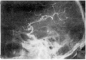 外傷性頸內動脈海綿竇瘺