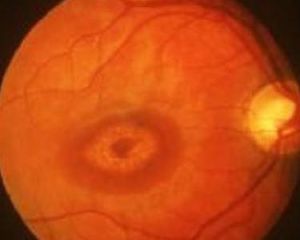 Stargardt病 Stargardt病