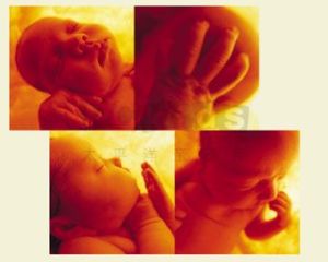 新生兒咽下綜合徵