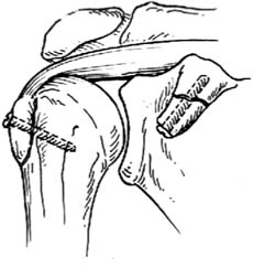 內固定術 內固定術