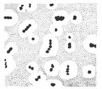 肺炎球菌腦膜炎