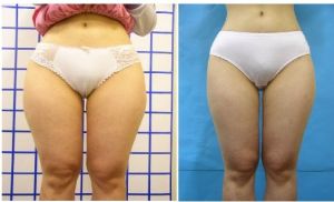 大腿吸脂術（效果對比圖） 