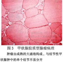 (圖)甲狀腺腺瘤