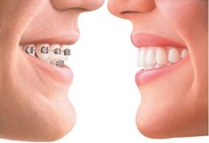 虎牙矯正