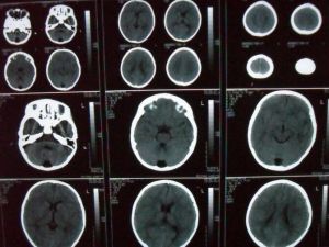 枕大池囊腫 枕大池囊腫