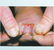 維生素B1缺乏病