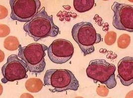 血清鹼性磷酸酶可呈進行性增高