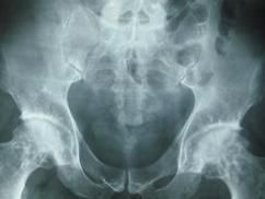 骨軟骨病 骨軟骨病