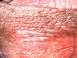 白色海綿狀痣 白色海綿狀痣