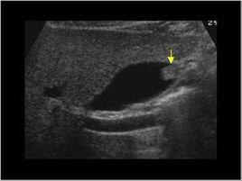 膽囊膽固醇性息肉 膽囊膽固醇性息肉