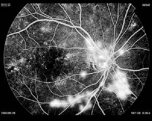 （圖）糖尿病視網膜病變