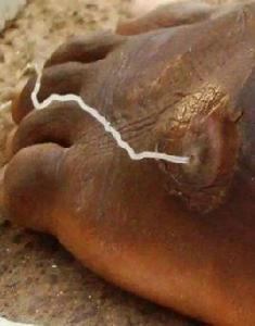 麥地那龍線蟲 麥地那龍線蟲