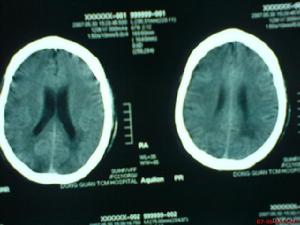 散發性腦炎 散發性腦炎