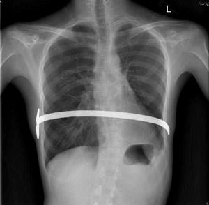 肺囊腫肺切除術