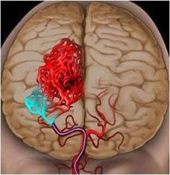 突發性腦溢血 突發性腦溢血