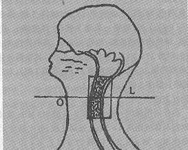 頭頸部腫瘤 頭頸部腫瘤