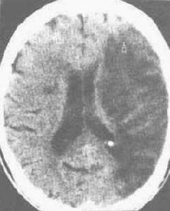 基底節腔隙性腦梗死 基底節腔隙性腦梗死