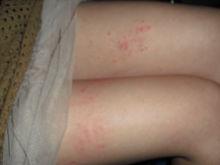 皮膚寄生蟲感染