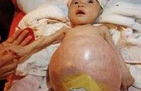 兒童腫瘤 兒童腫瘤