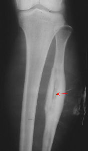化膿性骨髓炎 化膿性骨髓炎