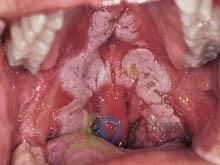 口腔黏膜白斑 