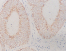 大腸腺瘤 大腸腺瘤