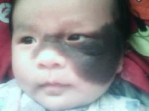 嬰兒面部胎記