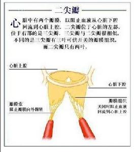 二尖瓣脫垂綜合症