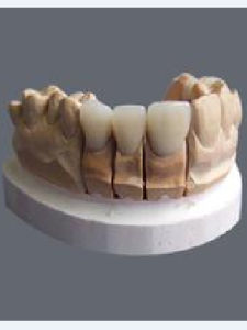 二氧化鋯全瓷牙 二氧化鋯全瓷牙