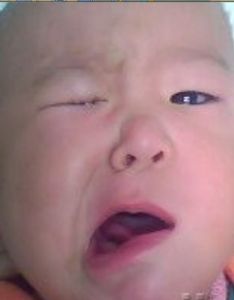 面部神經炎 面部神經炎