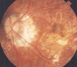 視盤傾斜 視盤傾斜