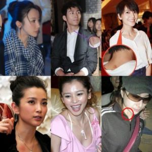 機械性紫斑 機械性紫斑