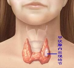 甲狀腺結節[微創術]