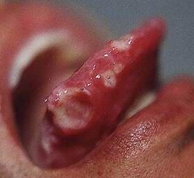 復發性阿弗它性潰瘍 復發性阿弗它性潰瘍