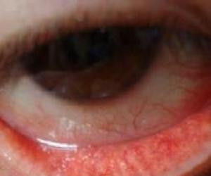 沙眼衣原體感染 沙眼衣原體感染