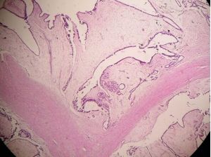 乳腺纖維腺瘤組織切片